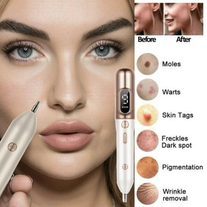 Wildbloom ™ -  Highest Rated Laser Freckle Removal Machine and Skin Tag Remover Pen
