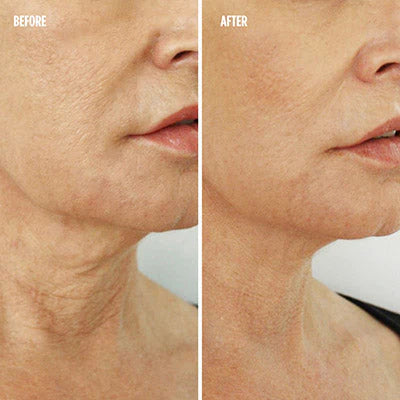 Wildbloom ™ High Frequency Skin Therapy wand 4 in 1